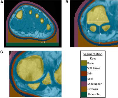 Predicting Forefoot-Orthosis Interactions in Rheumatoid Arthritis Using Computational Modelling